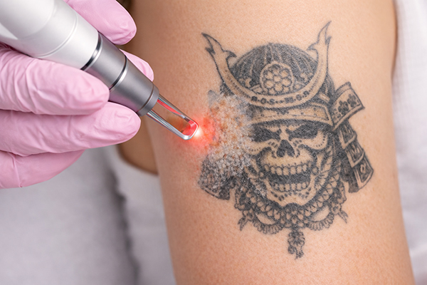 Laserowe usuwanie tatuaży