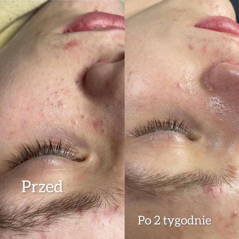 Oczyszczanie 03