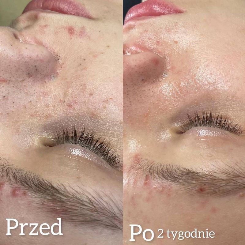 Oczyszczanie 04