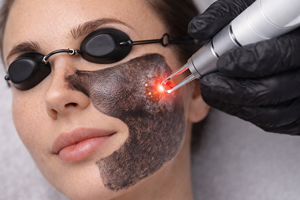 Laserowy peeling węglowy