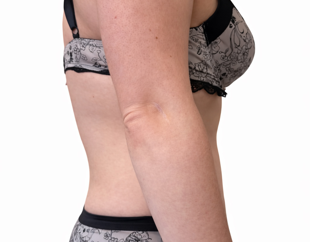 Po endermologia2